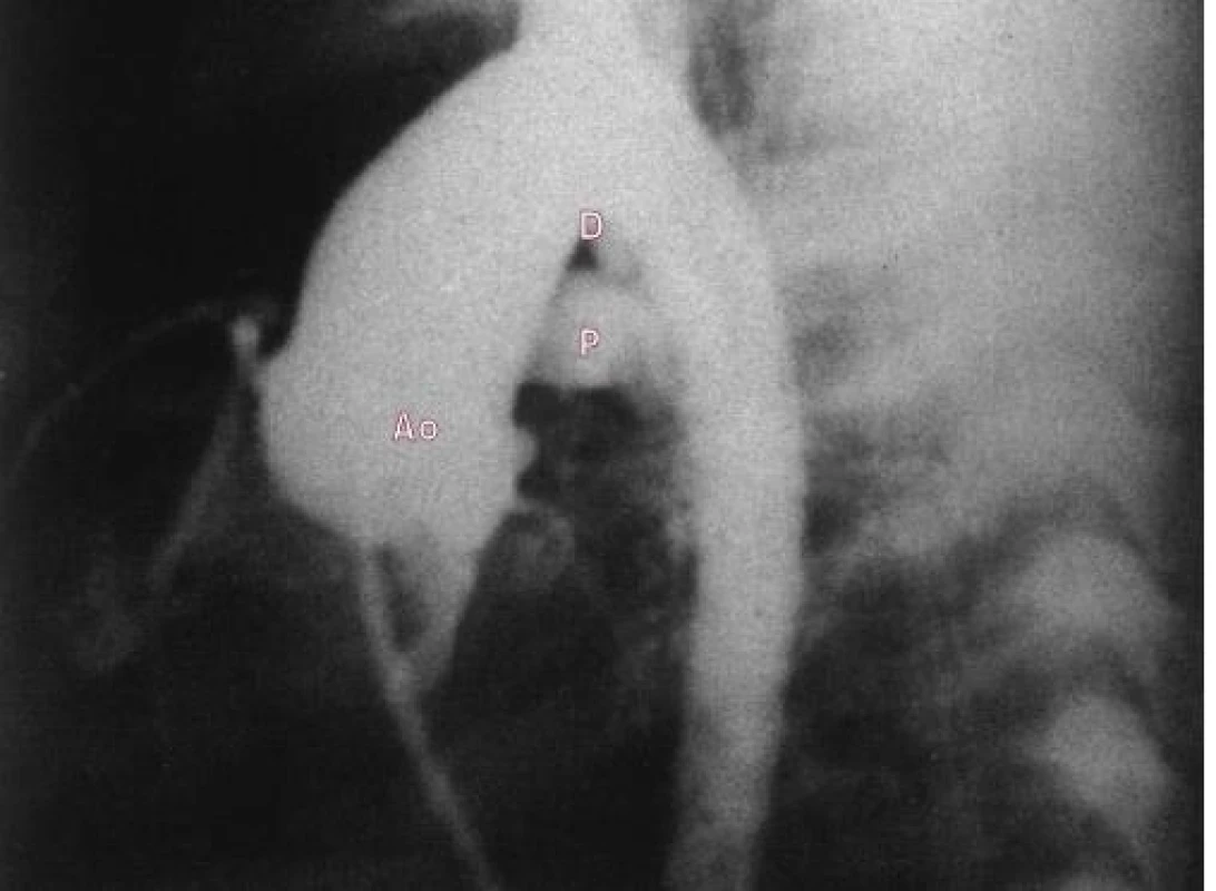 Aortogram (laterální projekce) ukazuje malou dučej.