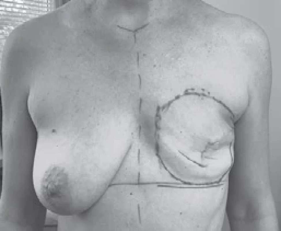 Preoperative markings.
