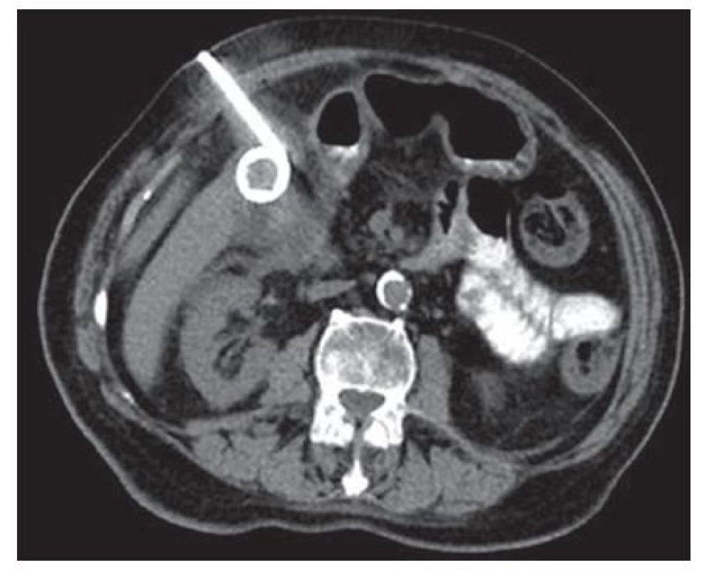 Transabdominální perkutánní drenáž žlučníku
Fig. 5: Percutaneous transabdominal gallbladder drainage
