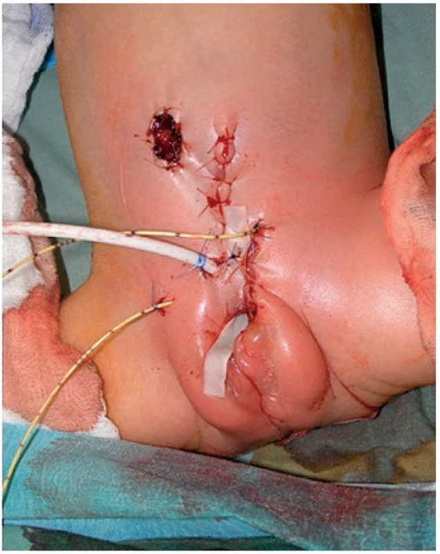 Po rekonstrukci exstrofie kloaky s vytvořením kolostomie.
Fig. 4. After reconstruction of the bladder and colostomy.