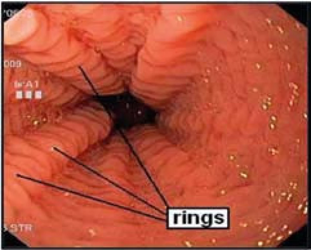 Endoskopický obraz výrazného krepování (rings) sliznice jícnu u pacienta s dg. EoE.
Fig. 3. Endoscopic image of significant rings of the esophageal mucosa in a patient with EoE.