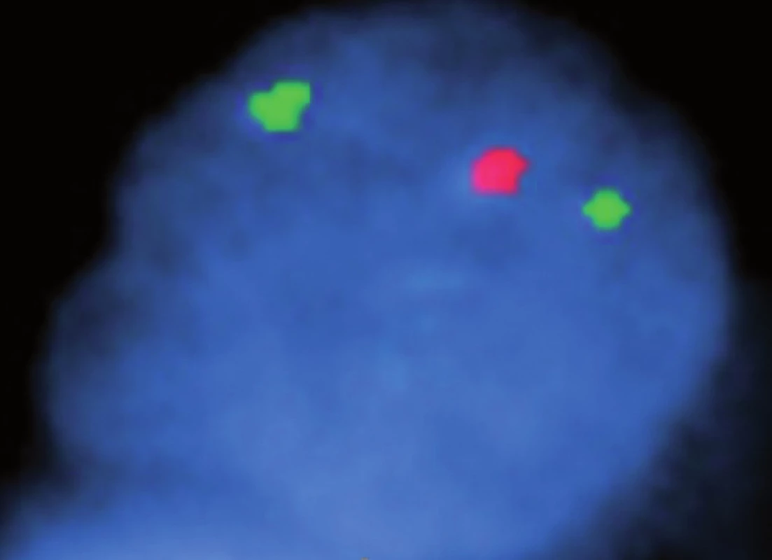 Pozitivní delece 1p36 (fluorescence in situ hybridization).