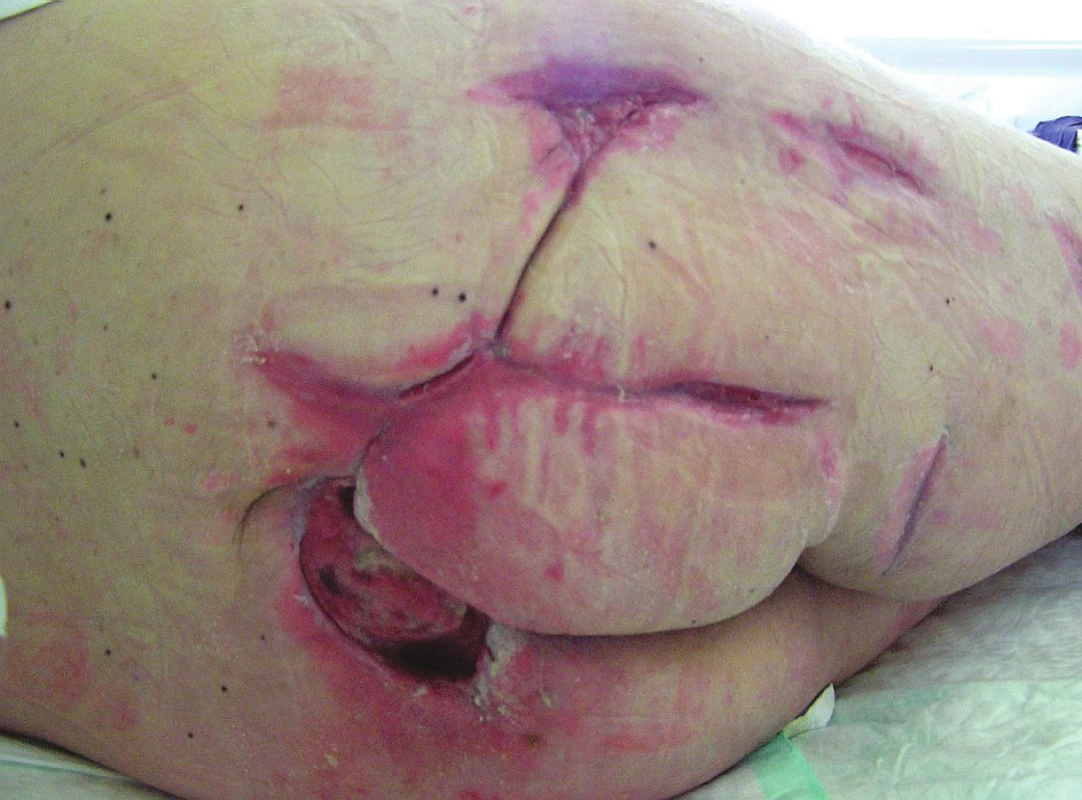 Defekty gluteální a kyčelní krajiny před překladem na rehabilitaci
Fig. 6. Defects of the gluteal, sacral and right hip area before patient´s transfer from our department