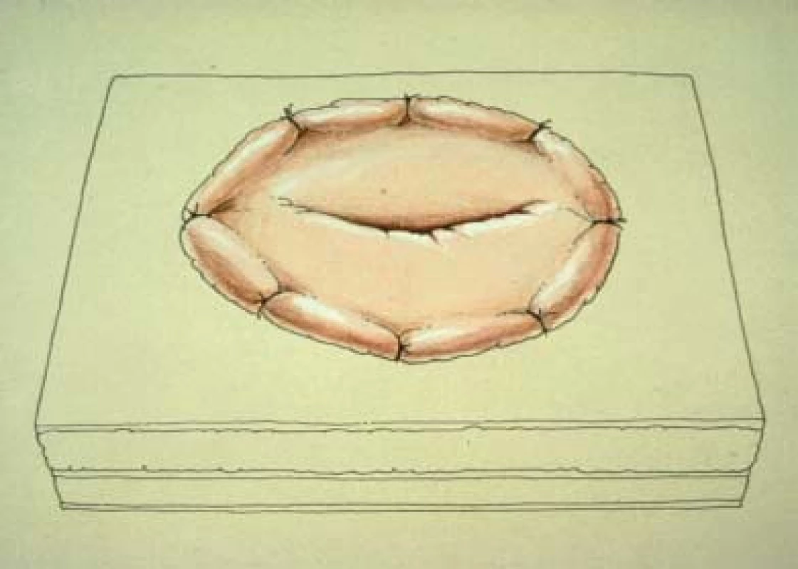 Tyto ilustrace ukazují techniku vytvoření stomatu eferentní větve.
a. Průměr stomatu je přibližně 1,5 cm. Z důvodu zajištění eferentní větve jsou na špičky laloku anteriorní f. rectus umístěny stehy. 
b. Po připevnění eferentního laloku k fascii je stoma připevněno ke kůži.