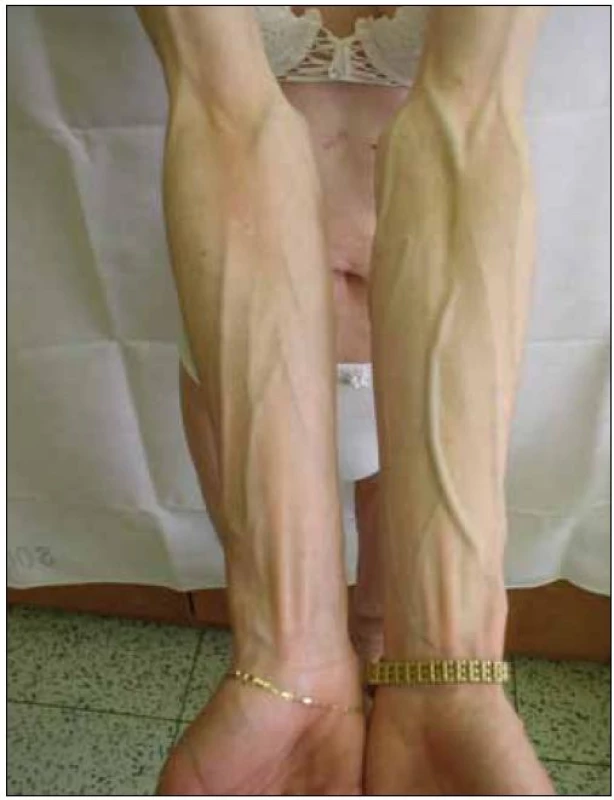 Lipoatrofie – prominence povrchových žil na horních končetinách. 