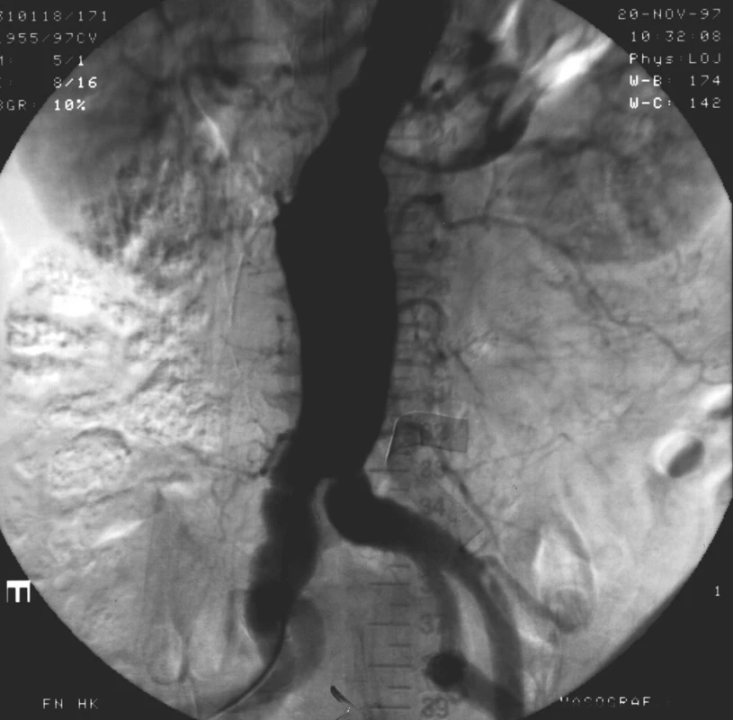 Angiografický nález bezprostředně po zavedení aorto-uniiliakálního stentgraftu
Fig. 1. Angiographic image immediate after implantation of aortouniiliac stentgraft