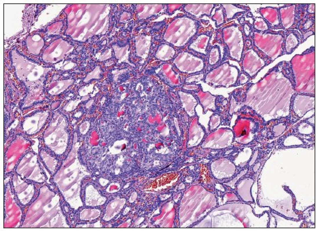 Papilární mikrokarcinom průměru 0,3 mm, ostře ohraničený,folikulární úpravy, bez známek agresivního chování. U těchtolézí je navrhováno používat označení papilární mikrotumor (H&amp;E,200krát)