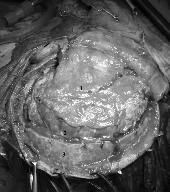 Plastika dury lalokem temporálního svalu a periostu, 1. periost, 2. dura mater, 3 kost