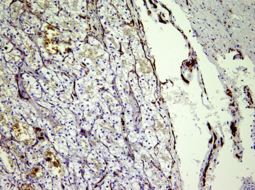 Povrch trombu je kryt endotelem, což je důkaz přítomnosti nádorové tkáně v cévě, CD 34, 200x
Fig. 2. The thrombus surface is covered by endothelium, providing the evidence of the neoplastic tissue presence in the vein, CD 34, 200x