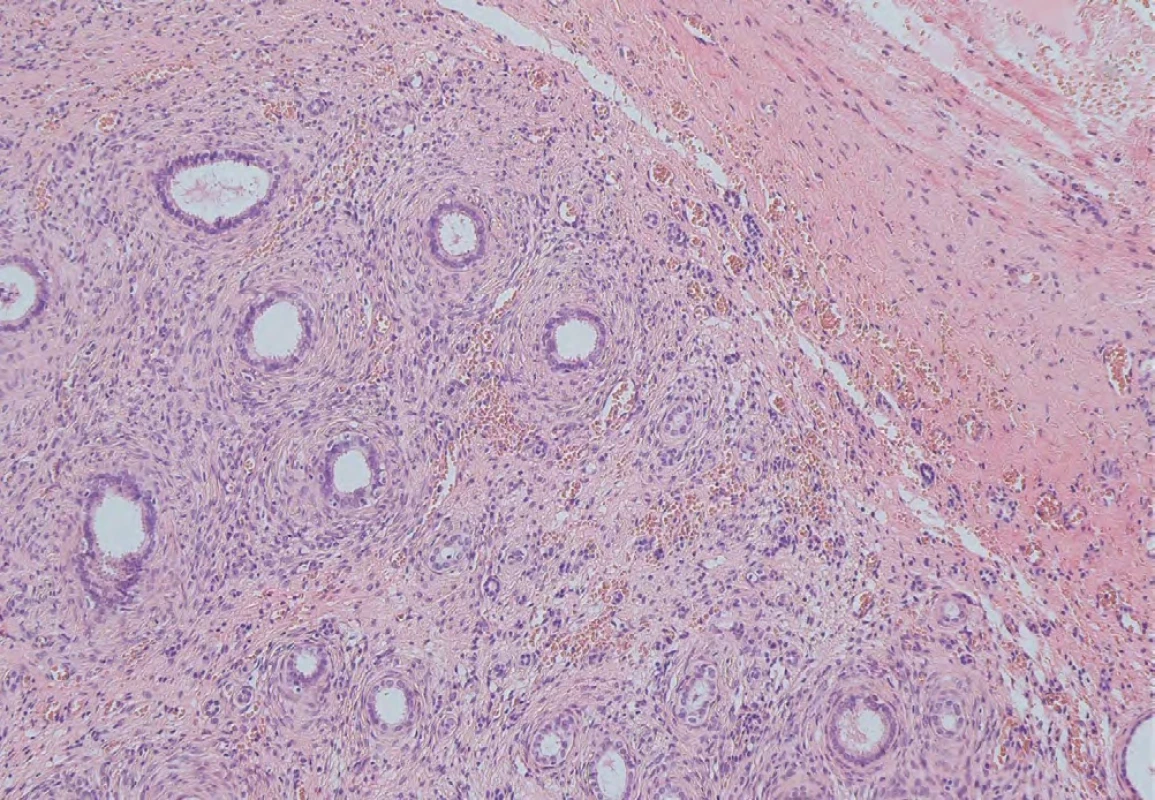 Metaplazie urotelu. Barvení: hematoxylin-eozin, zvětšeno 100×.