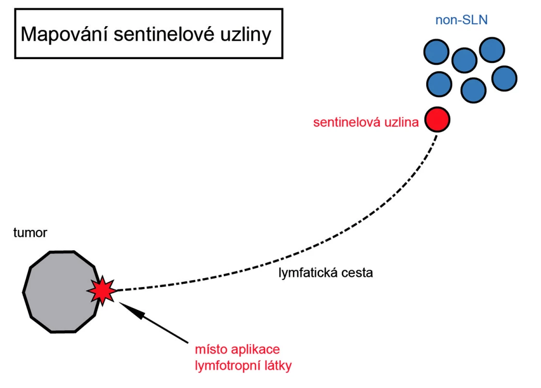 Mapování sentinelové uzliny
