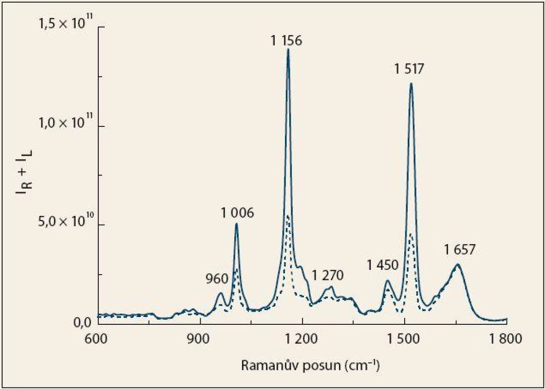 Průměrná Ramanova spektra krevní plazmy pacientů s karcinomem pankreatu (čárkovaná čára) a kontrolních jedinců (plná čára).
Fig. 1. The average Raman spectra of blood plasma from patients with pancreatic cancer (dashed line) and control subjects (solid line).
