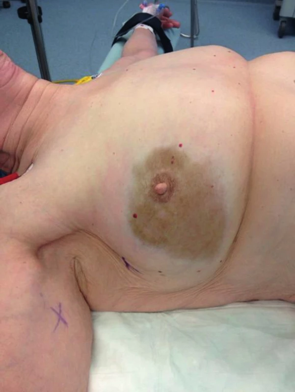 Hnědavě zbarvená skvrna na prsu po aplikaci Sienny
Fig. 5: Brownish-colored area of the breast following Sienna+ injection