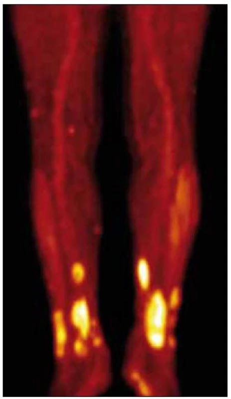PET CT končetin, je zřetelná velmi vysoká akumulace <sup>18</sup>fluorodeoxyglukózy v oblasti xantogranulomů, svědčící o jejich vysoké metabolické aktivitě.