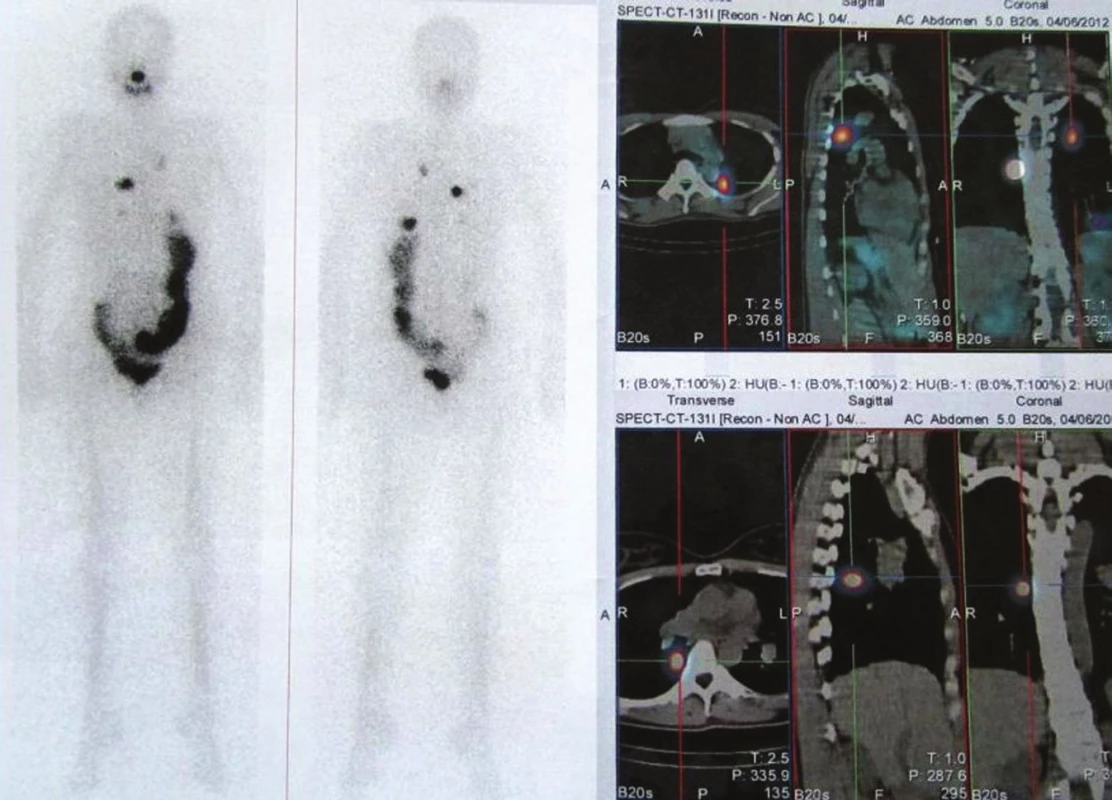 Stejný pacient jako na obr. 1, plicní metastázy.
Vysvětlivky: celotělová scintigrafie a SPECT/CT hrudníku po podání tyreoablační dávky RJ, hladina Tg 0,3 μg/l, anti-Tg 221 U/ml.