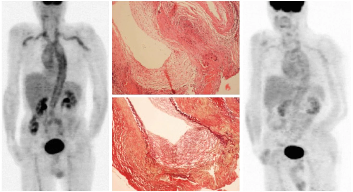 Kazuistika, muž 65 let s histologicky ověřenou temporální arteriitidou.