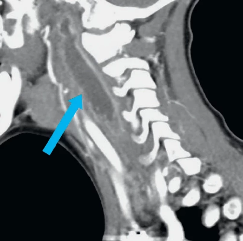 Retrofaryngeální absces – šipka (CT, sagitální řez). Zdroj: fotodokumentace ORL kliniky FN Plzeň.