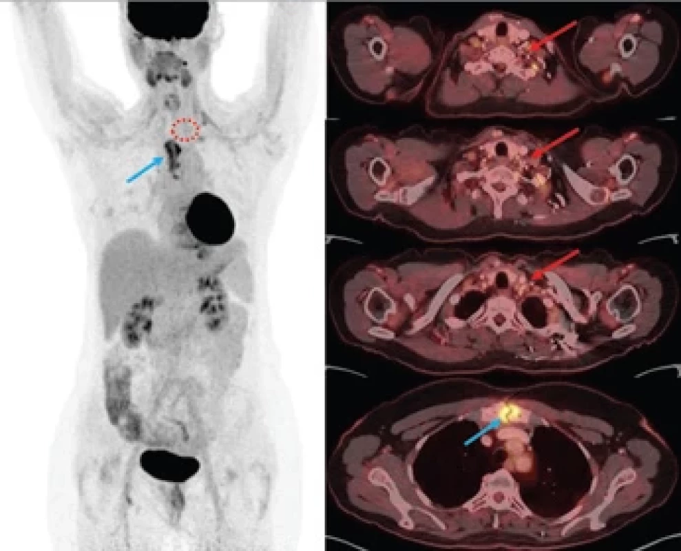 FDG-PET/CT kontrola potvrzující totální odstranění původního ložiska Castlemanovy choroby.