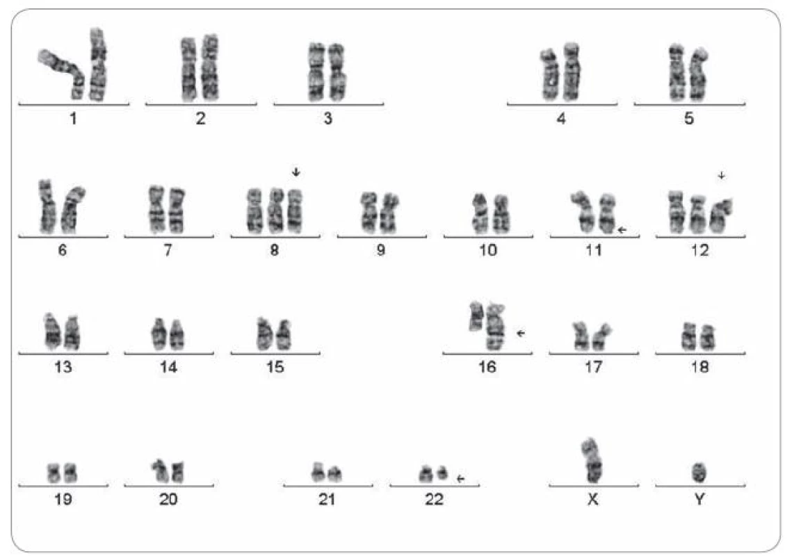 Pacient s ES/ PNET lopaty kosti kyčelní a plicními metastázami, zemřel za 2 roky od stanovení diagnózy. Karyotyp s indikátory negativní prognózy: 48,XY,+8, t(11;22)(q24;q12),– 16,der(16)t(1;16)(q21;q13),+12[6]/polyploidní mitózy. Cytogenetické vyšetření bylo upřesněno arrayCGH: arr cgh 1q21.2q44(RP11– 326G21&amp;rarr; GS–167K11)×3,8(167 BAC)×3,12(166 BAC)×3,16q12.1q24.3 (RP11– 283C7&amp;rarr;RP11– 533D19)×1.