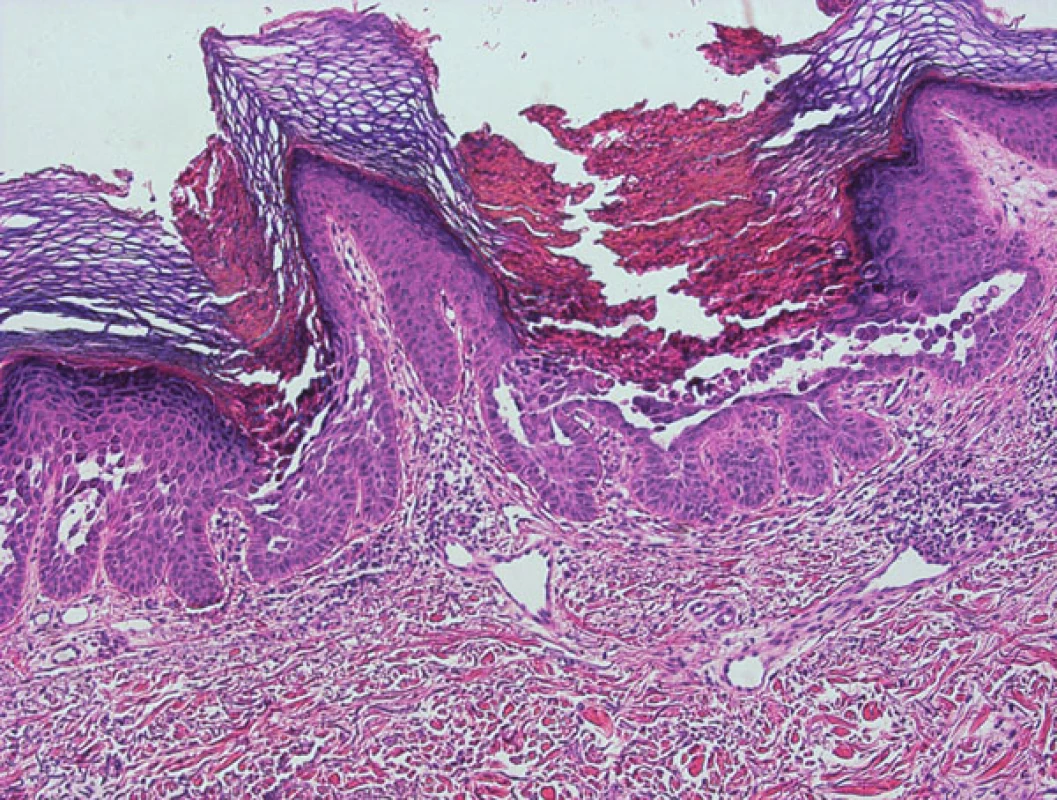 Morbus Darier – suprabazální akantolytické štěrbiny v epidermis (HE, zvětšeno 100x).