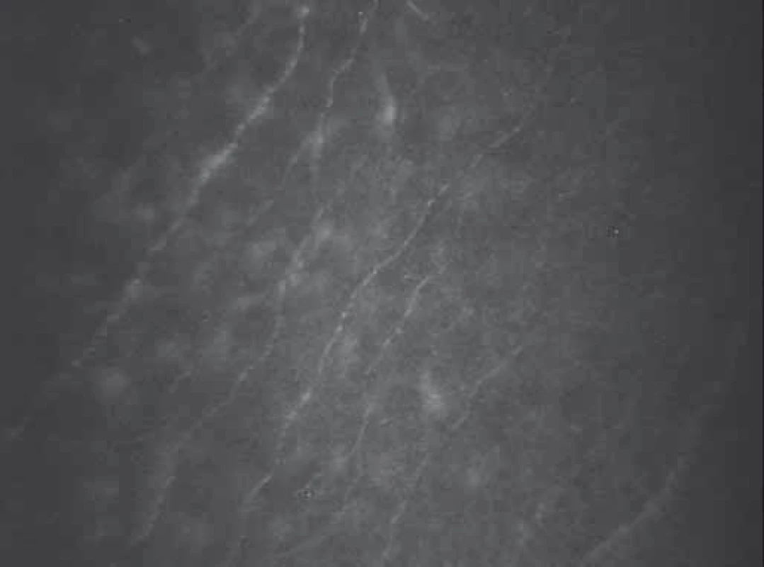 Nervová vlákna subbazálního nervového plexu u zdravého subjektu.
Fig. 1. Corneal sub-basal nerve fibers of a healthy subject.