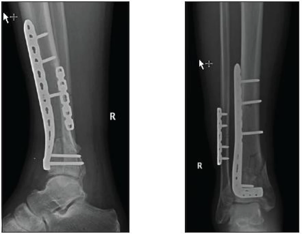 Osteosyntéza anterolaterální 3,5 mm LCP dlaha a rekonstrukční LCP dlaha na fibule (KÚCH)