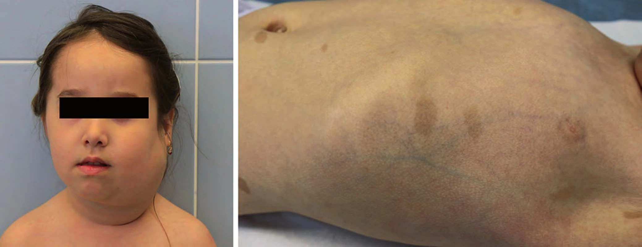 Neurofibromatóza typ I. A. plexiformní neurofibrom krku; B. café-au-lait na kůži.