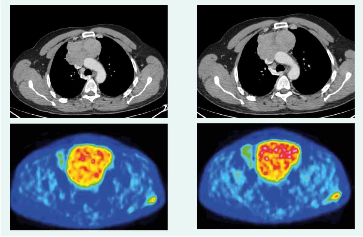 CT a PET CT z mája roku 2017. Z archívu spoluautorky MUDr. M. Černej, CSc.
