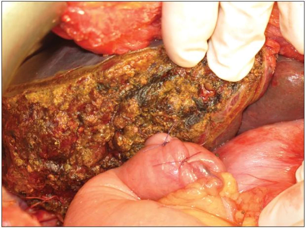 Resekční plocha po pravostranné rozšířené hepatektomii s našitím exkludované jejunální kličky na levý hepatikus
Fig. 10: Resection surface after extended right hepatectomy and anastomosis of jejunal loop with left hepatic duct