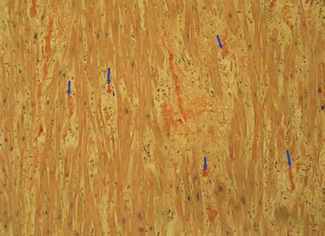 Myokard-amyloid – Kongo100krát: myokard explantovaného srdce s amyloidózou, barvení Kongo červení, zvětšení 100krát. Šipky ukazují amorfní červeně obarvená depozita amyloidu v intersticiu myokardu, je patrné disperzní rozložení depozit.