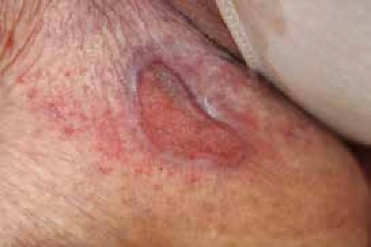 Pyoderma gangrenosum