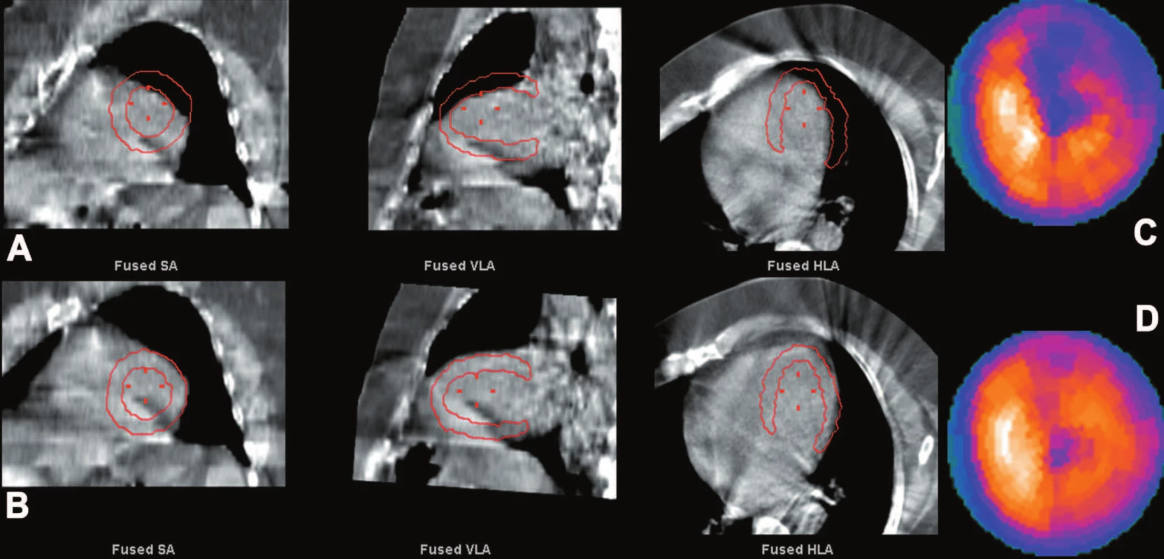 Ukázka nepřesné registrace SPECT a CT obrazů (A) s vytvořením nesprávné korekční mapy a chybnou korekcí na zeslabení. V tomto případě je výsledkem arteficiální perfuzní defekt na přední a boční stěně (C). Při přesné registraci SPECT a CT obrazů (B) a správné korekci na zeslabení je perfuze myokardu téměř normální (D). Chyba v registraci SPECT a CT obrazů je pro větší názornost záměrně zveličena.