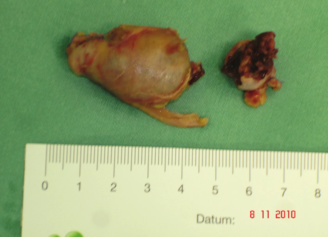 Trombózované PVA
Fig. 5: Thrombosed PVA