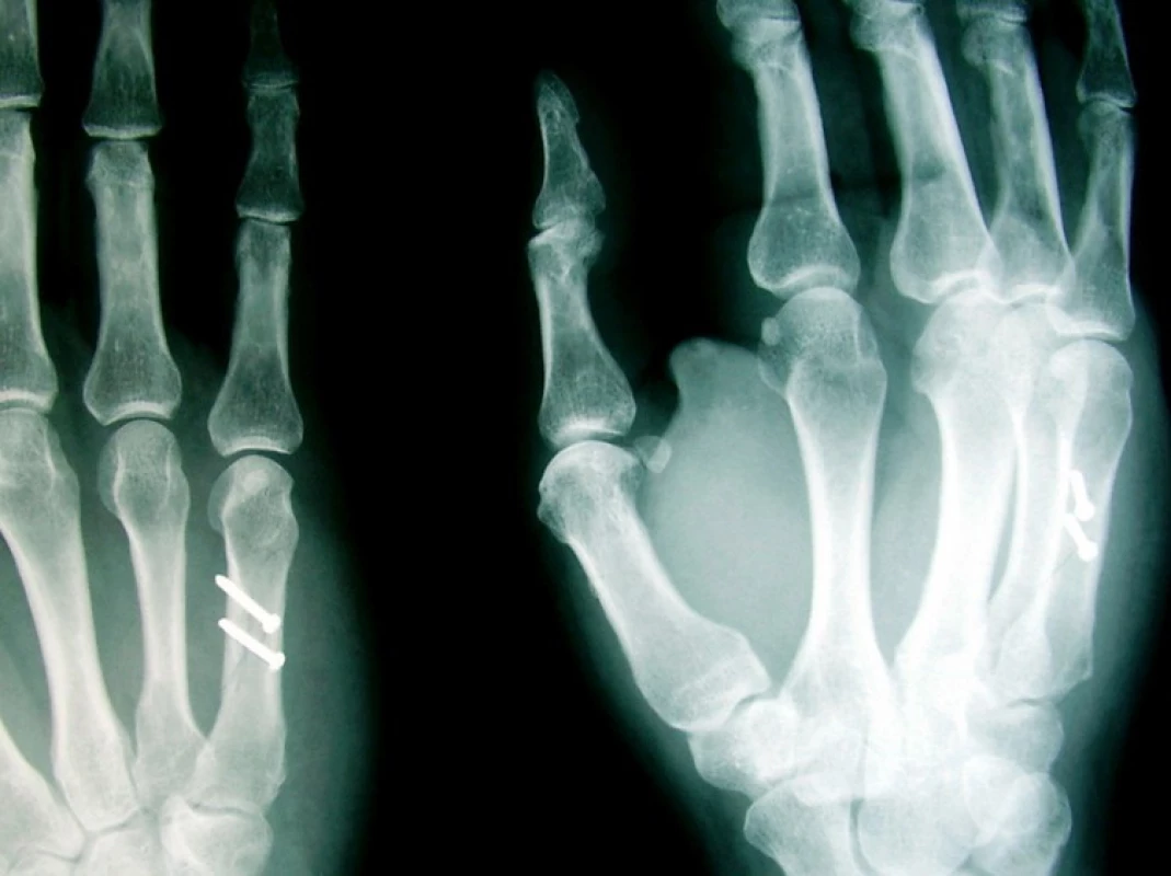 Spirální zlomenina diafýzy (a) s osteosyntézou samostatnými šrouby (b)