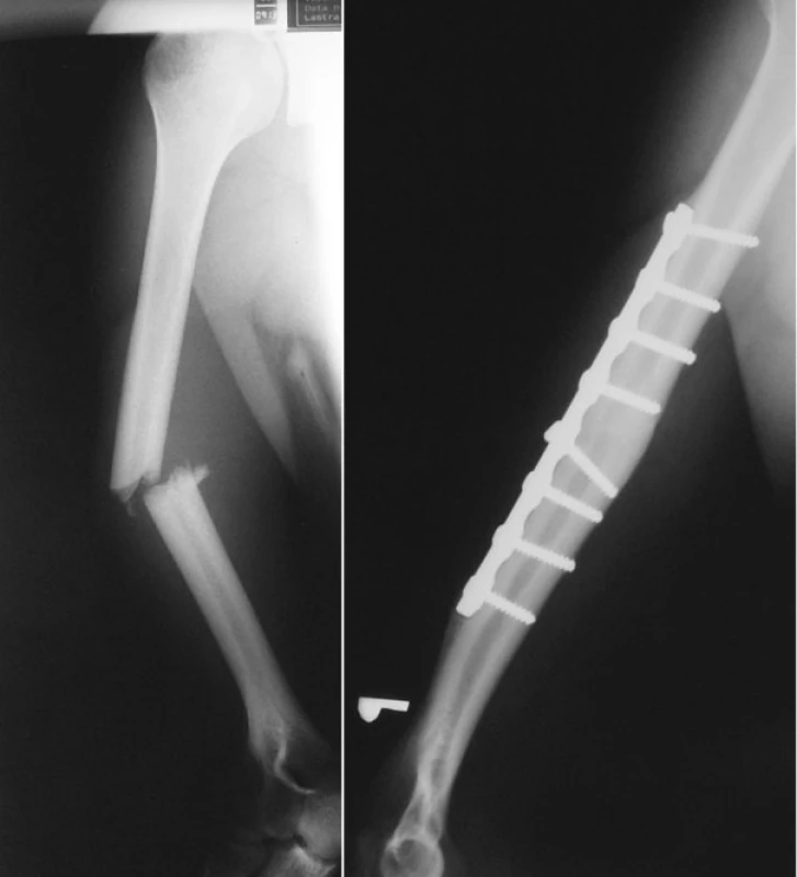 a. RTG obraz zlomeniny diafýzy pažní kosti 
Pic. 1a. X-ray picture of the humeral shaft fracture
b. RTG obraz zhojené zlomeniny diafýzy pažní kosti po ORIF (otevřené repozici a dlahové osteosyntéze)
Pic. 1b. X-ray picture of the healed humeral shaft fracture after ORIF
