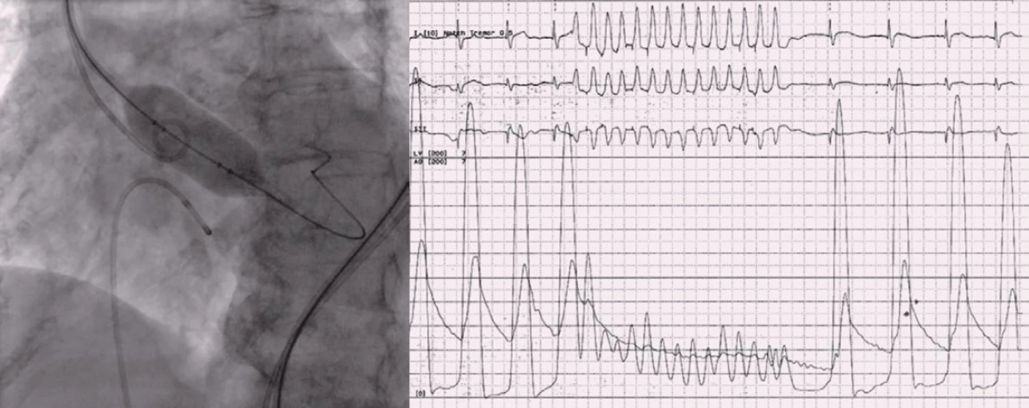 Před implantací chlopně je prováděna balónková valvuloplastika za praktické krátkodobé zástavy oběhu dosažené rychlo u stimulací komor.