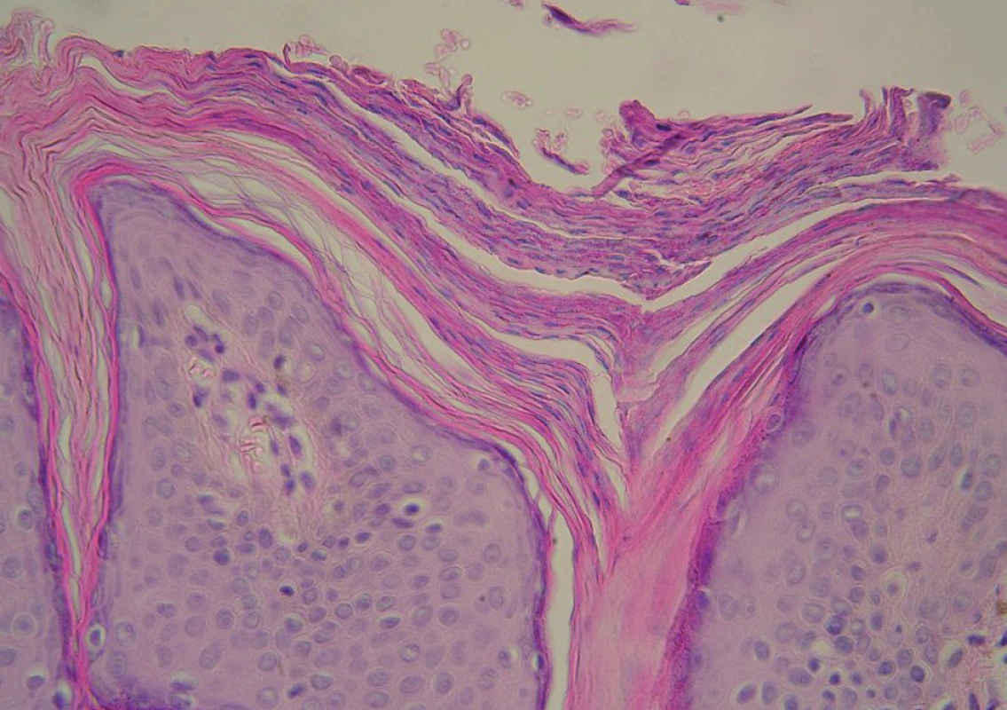 Histologie – případ 3: granulární parakeratóza (HE, zvětšení 400krát).
