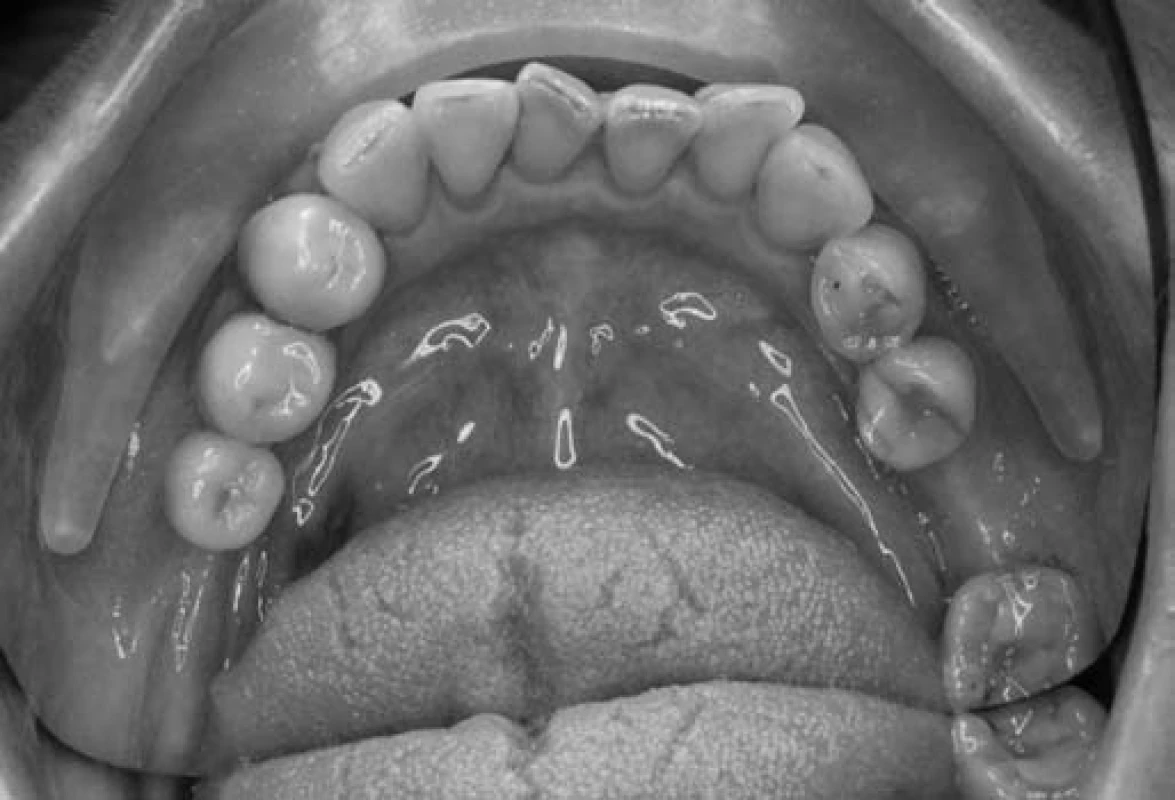 Oploštenie a stesnanie dolného frontálneho úseku u pacientky č. 1.
Fig. 2. Flattened and crowded lower frontal segment in patient No. 1.