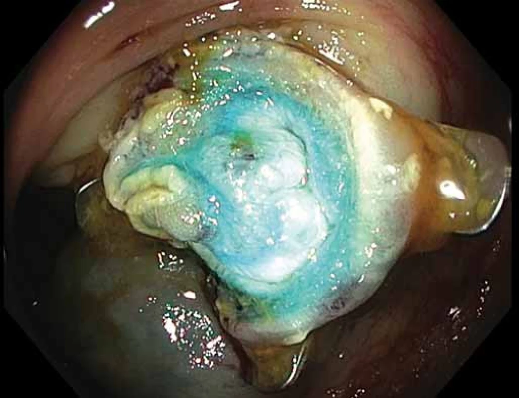 Naložený OTS klip po transmurální resekci (příznak tere).
Fig. 6. Deployed OTS clip after full-thickness resection (“target sign”).