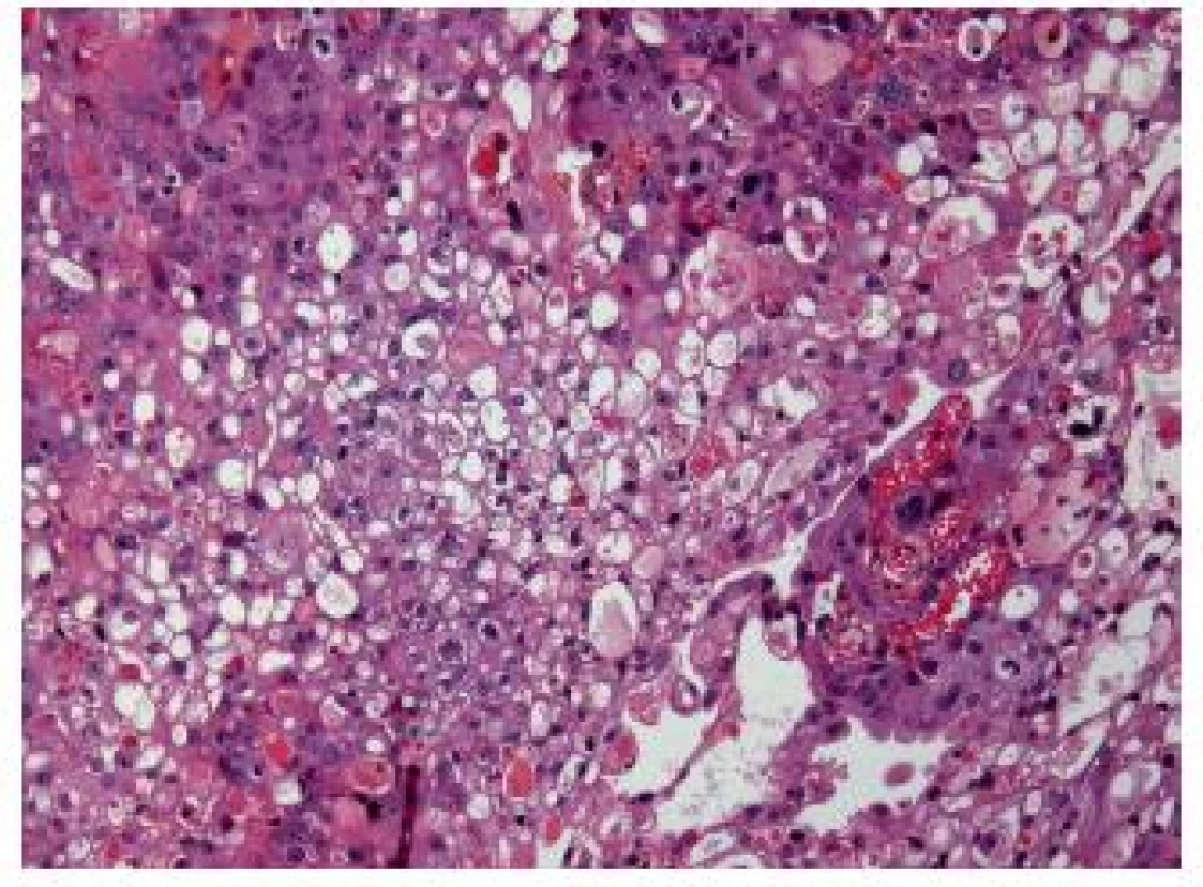 Lipid-rich variant, this UC is poorly differentiated.