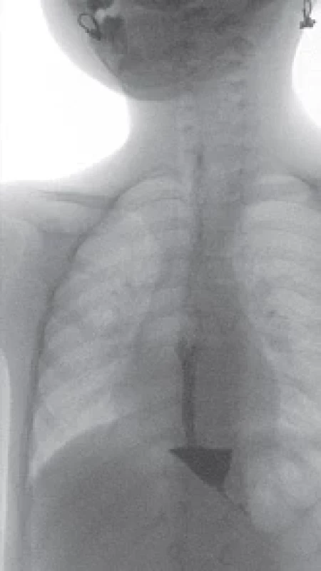 Signifi cant esophageal dilation, 27 mm in the distal third, with stagnation of contrast material above the cardia. Obr. 1. Výrazná dilatace jícnu, 27 mm v distální třetině, se stagnací kontrastní látky nad kardií.