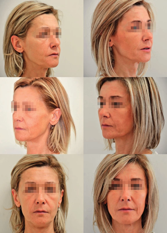 A case of a 45-year-old female patient with profound deflation of the face seeking rejuvenation. Originally she requested filler injection but was offered facial fat grafting. The figure shows pre- and postoperative photographs. There was a total of 24 ml of microfat injected and included deep filling of malar, tear trough area and nasolabial folds, superficial fat grafting to the cheeks. Note mainly the change of contour of the malar area on the 45° view
