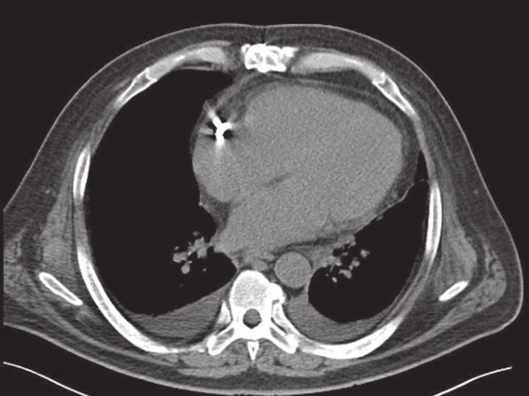Intraperikardiálně uložený drenážní katétr
Fig. 3: Intrapericardial placement of the drainage catheter