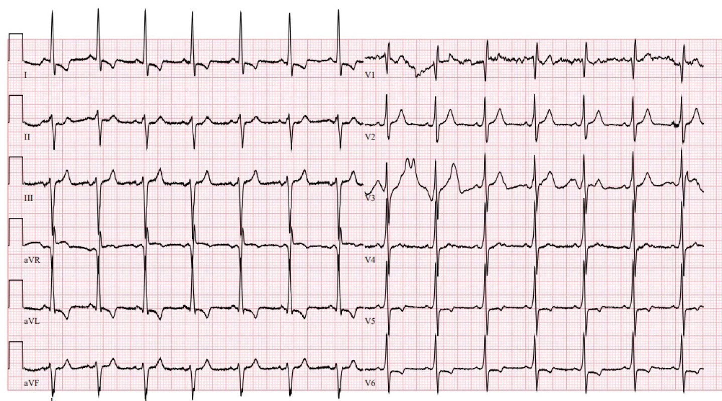  EKG: krátký interval PQ (115 ms), sinusový rytmus, známky hypertrofie a zatížení levé komory, kratší AV přechod – 47letý pacient s Fabryho chorobou (zdroj: II. interní klinika – klinika kardiologie a angiologie 1. LF UK a VFN v Praze)