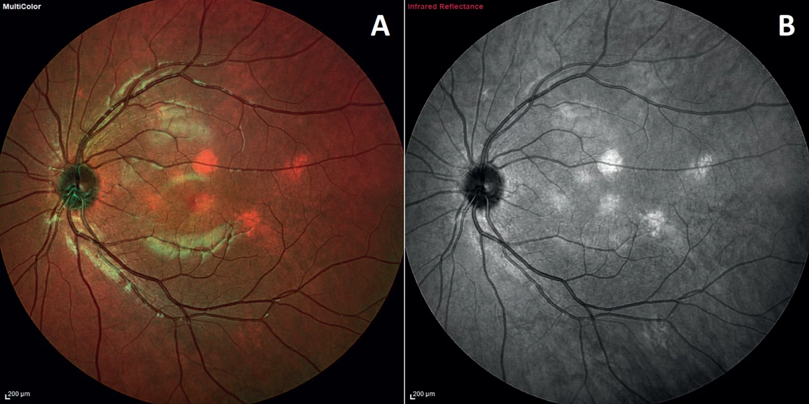Comparison of visualization of choroidal nodules on pseudocolor MultiColor image