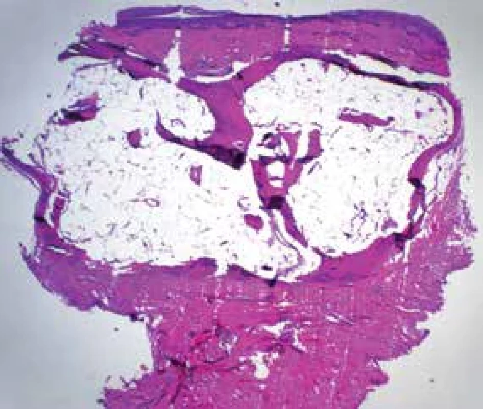 a,b. Osteoma cutis vytvořený v terénu jizvy po excizi melanomu