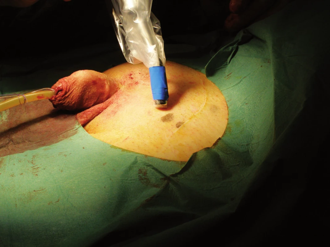 Peroperační použití gamakamery
Fig. 2. Intraoperative use of gamacamera