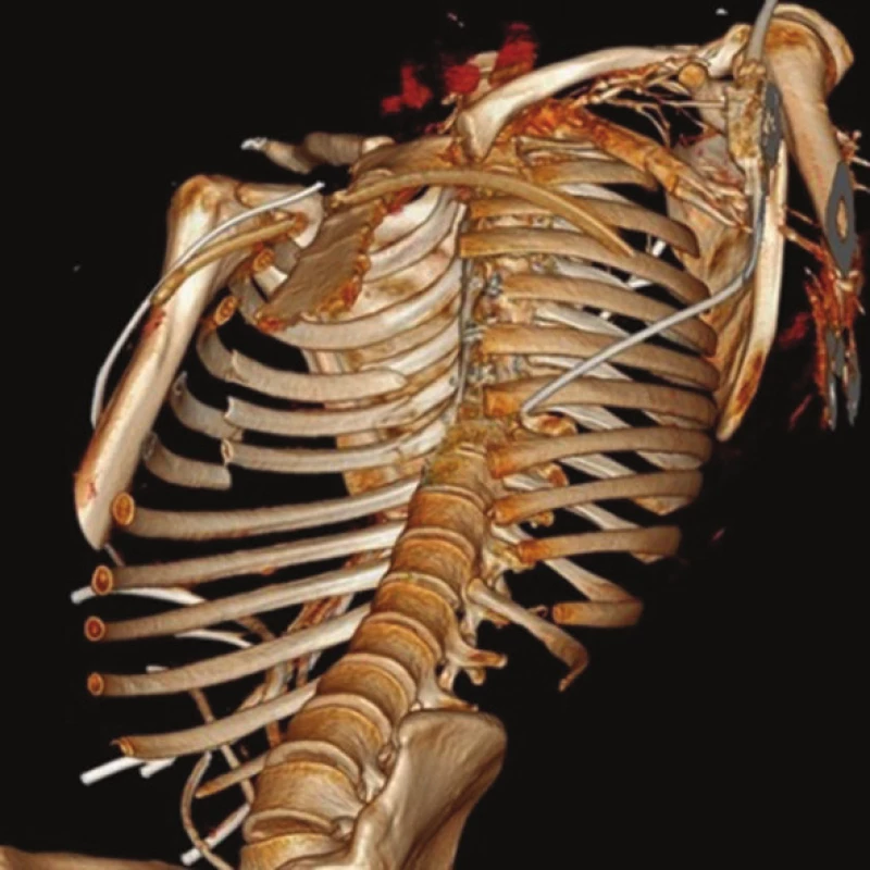 3D rekonstrukce
Fig. 5: 3D CT reconstruction