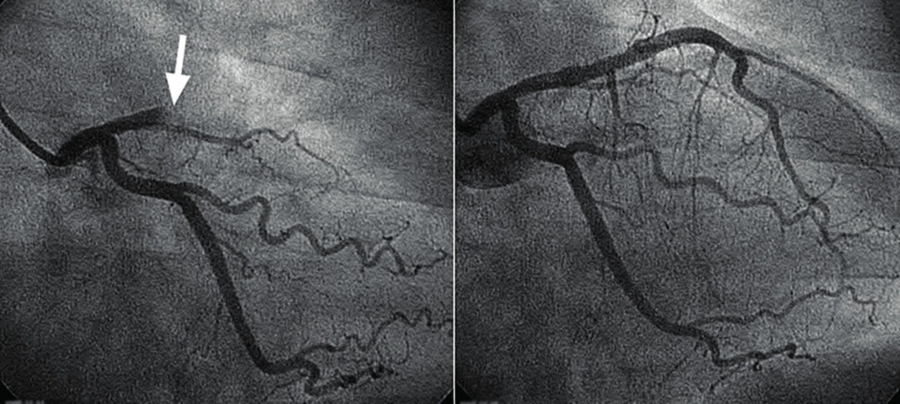 Angioplastika jedné z magistrálních tepen zásobujících srdeční sval (ramus interventricularis anterior) Při nástřiku kontrastní látkou je patrná obstrukce toku krve (šipka). Po nafouknutí balonku a implantaci stentu je překážka odstraněna a průtok krve v celém rozsahu obnoven.
