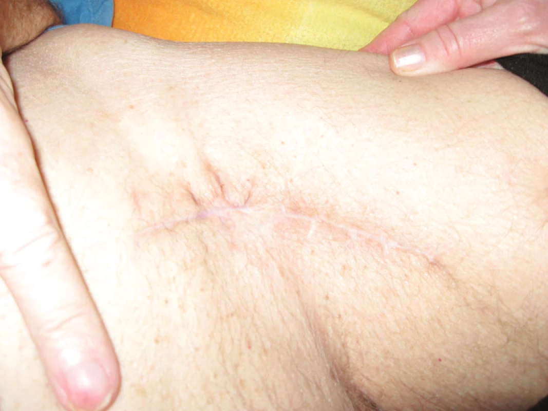 Stav po zhojení
Fig. 10. Result after the wound healing